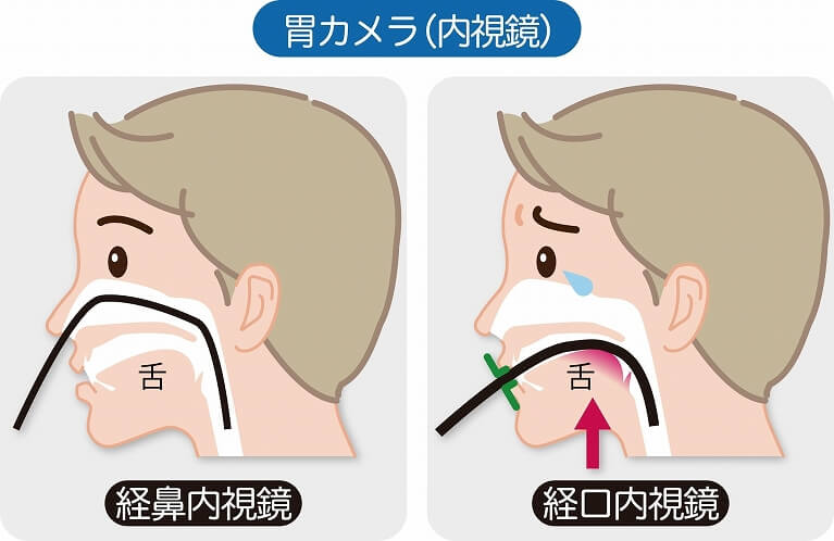 苦痛を抑えた鼻からの胃カメラ検査