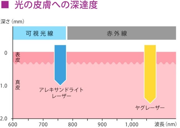 宮崎県串間市・日南市・都城市・志布志市でジェントルマックスプロの医療脱毛を提供しているはなぶさ消化器・内視鏡クリニック、医療脱毛イメージ図